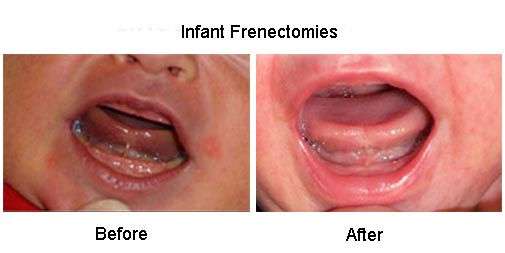 pediatric laser frenectomy with Solea laser