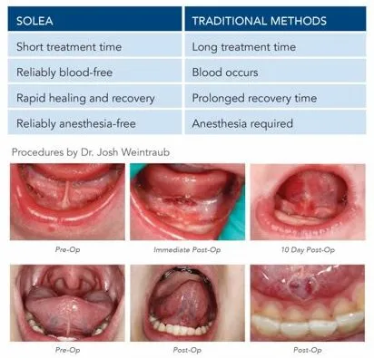 pediatric laser frenectomy with Solea laser